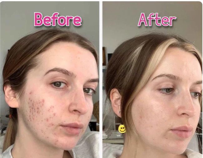 LED Face & Neck Wrinkle Massager!  [With Free of Cost GIFT]