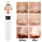 BLACK HEADS ACNE OIL REMOVER 5 in 1