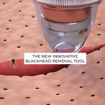 BLACK HEADS ACNE OIL REMOVER 5 in 1
